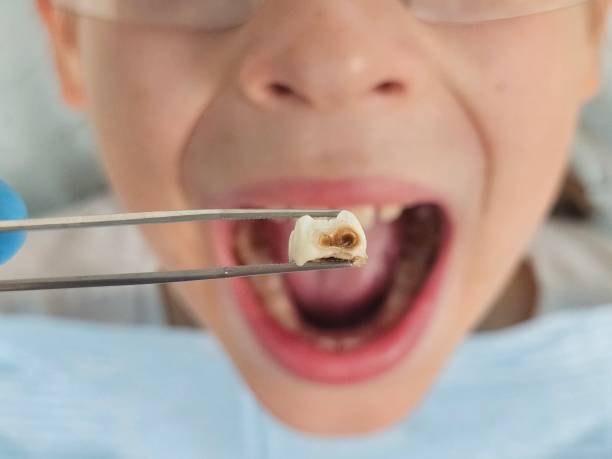Best Urgent Care for Lost Fillings or Crowns in Centre Grove, NJ